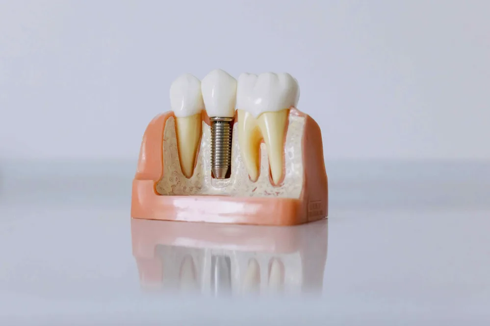 Dental implant crossection