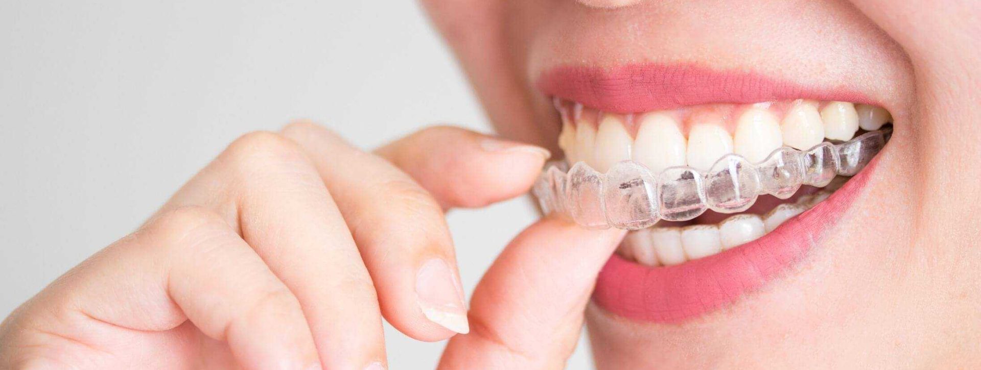 Invisalign vs. Spark
Which Clear Aligner Is Right for You?