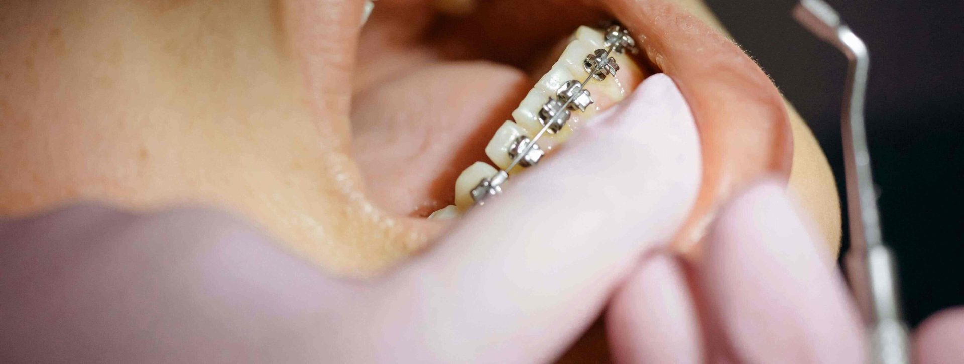 Fixed 
Braces