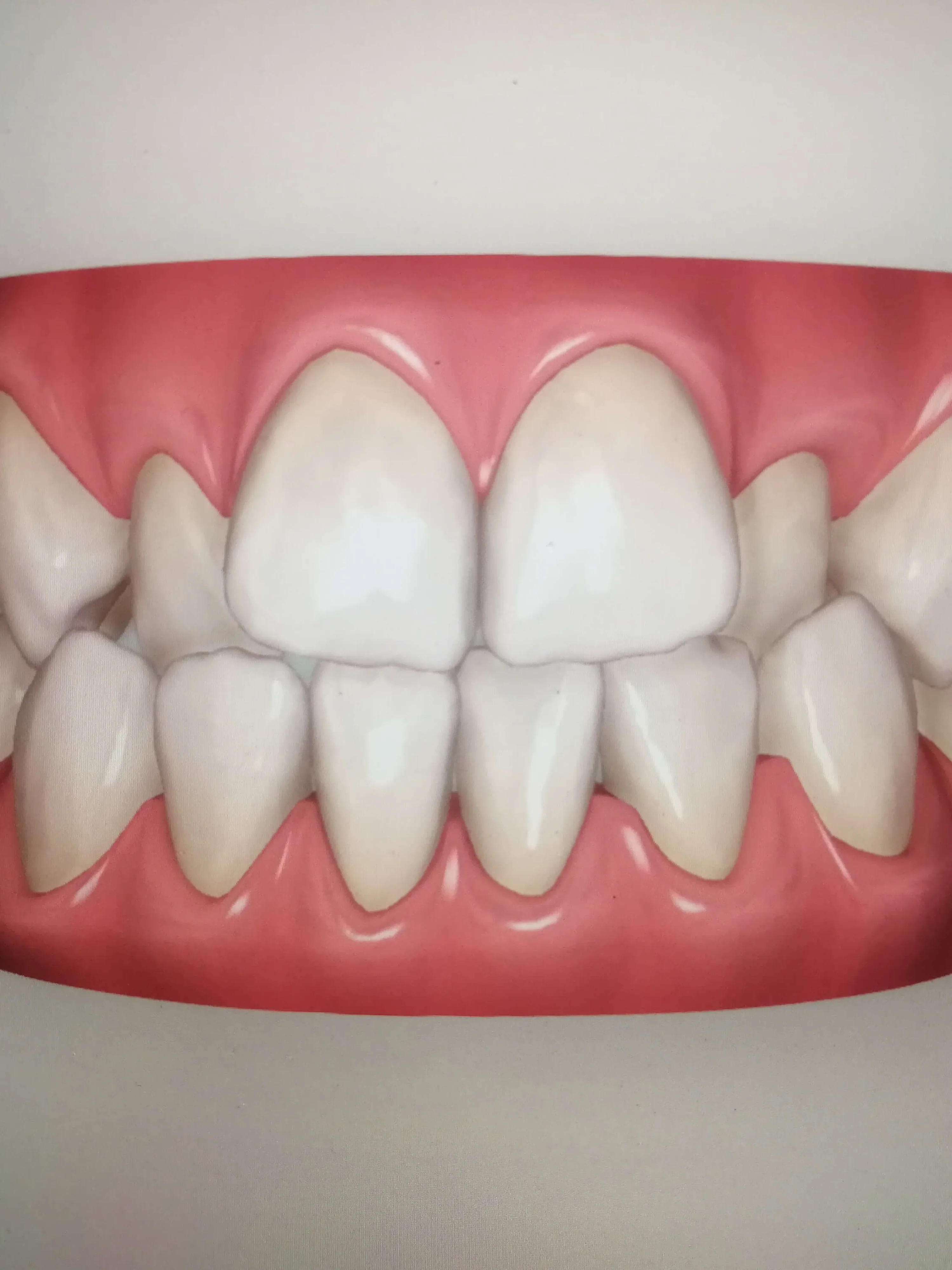 Invisalign patient before