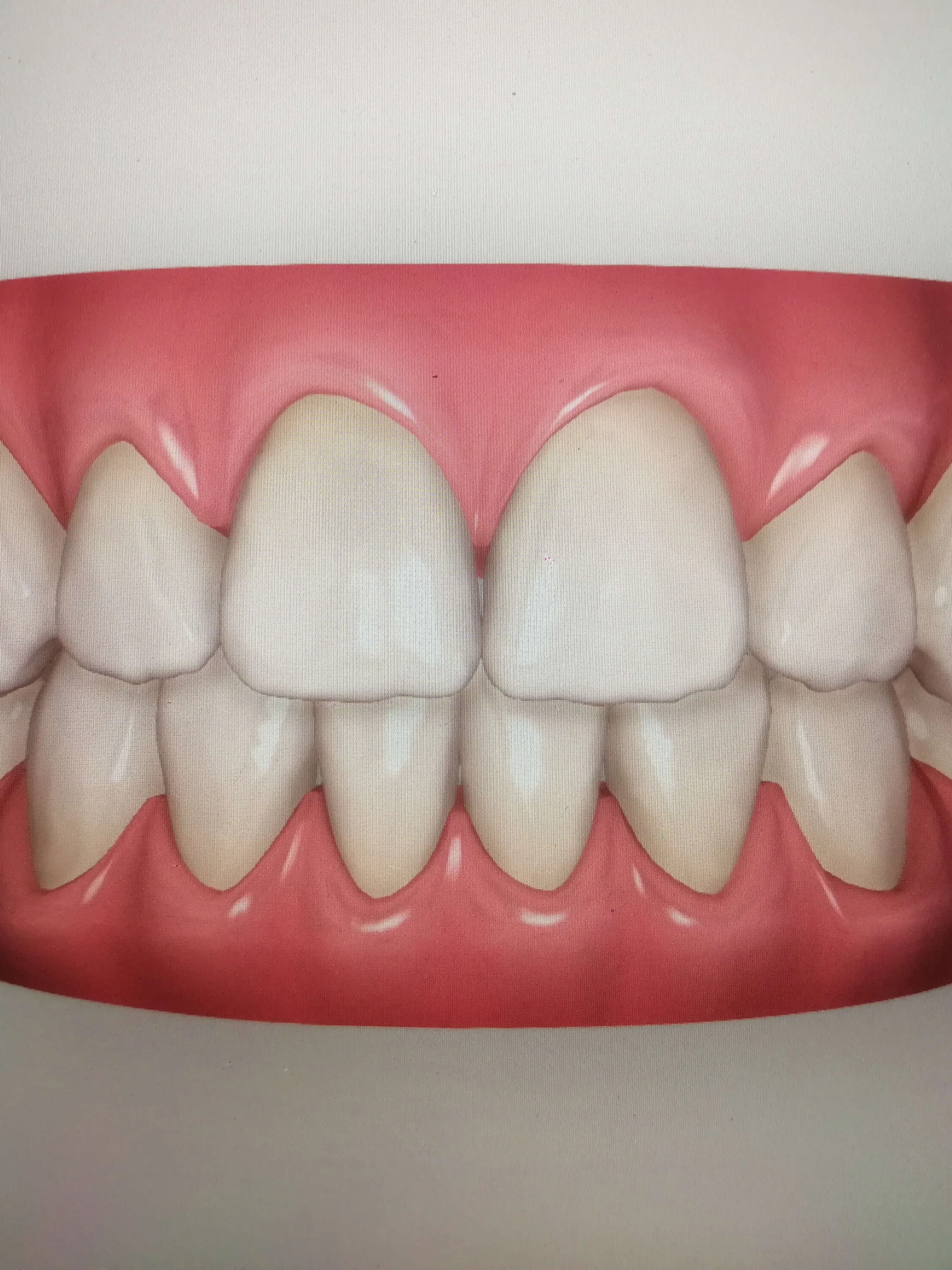 Invisalign patient after